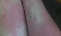 吃籽瓜过敏了,吃籽瓜过敏紧急应对指南